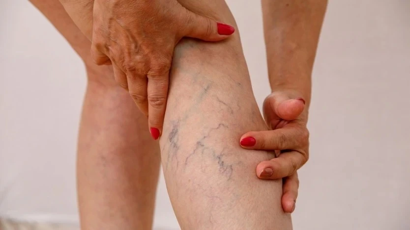 The ultimate guide to understand Varicose Veins