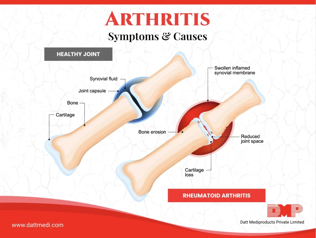 ARTHRITIS & Its Different Types