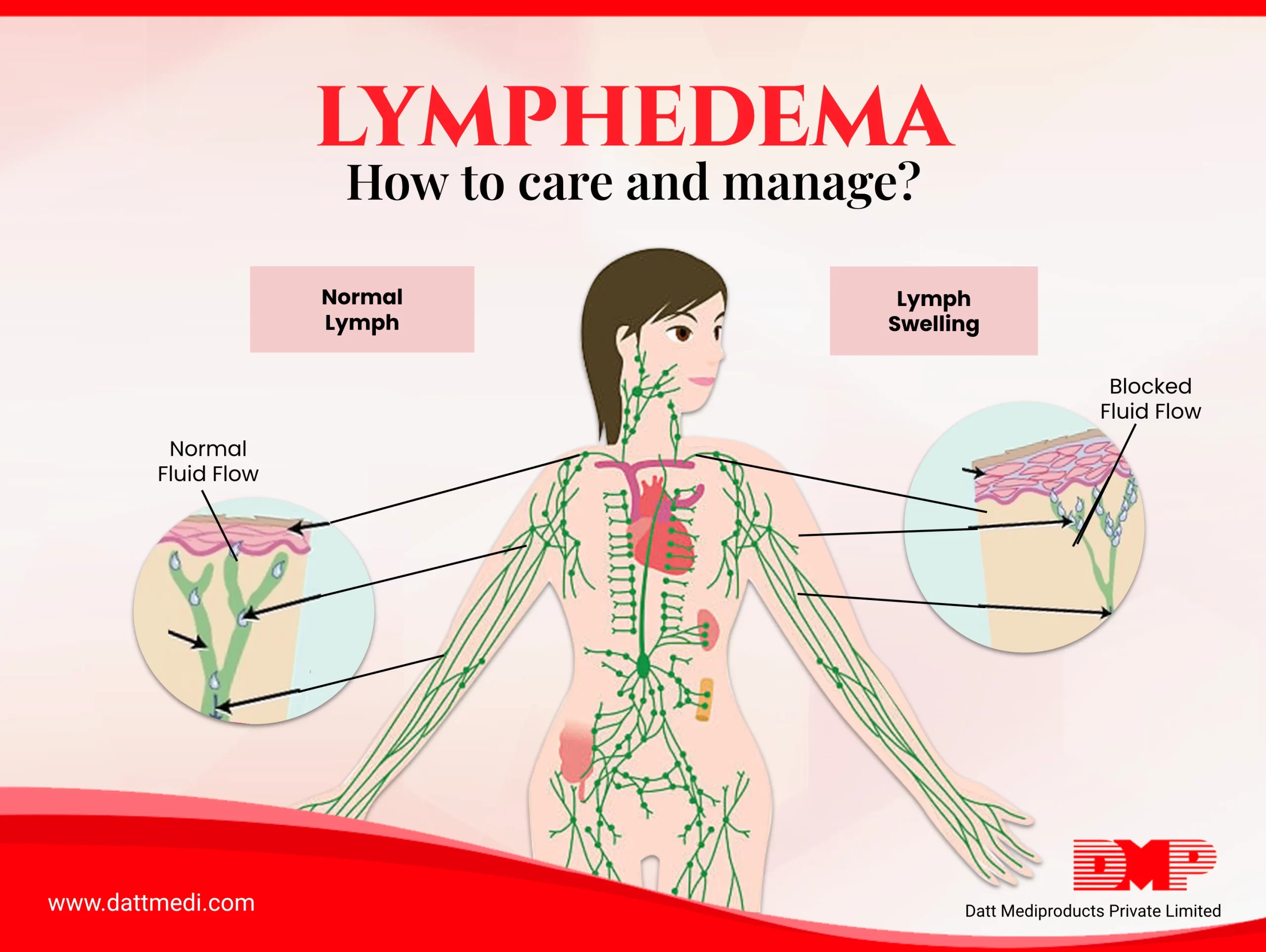 Lymphedema How to care and manage?