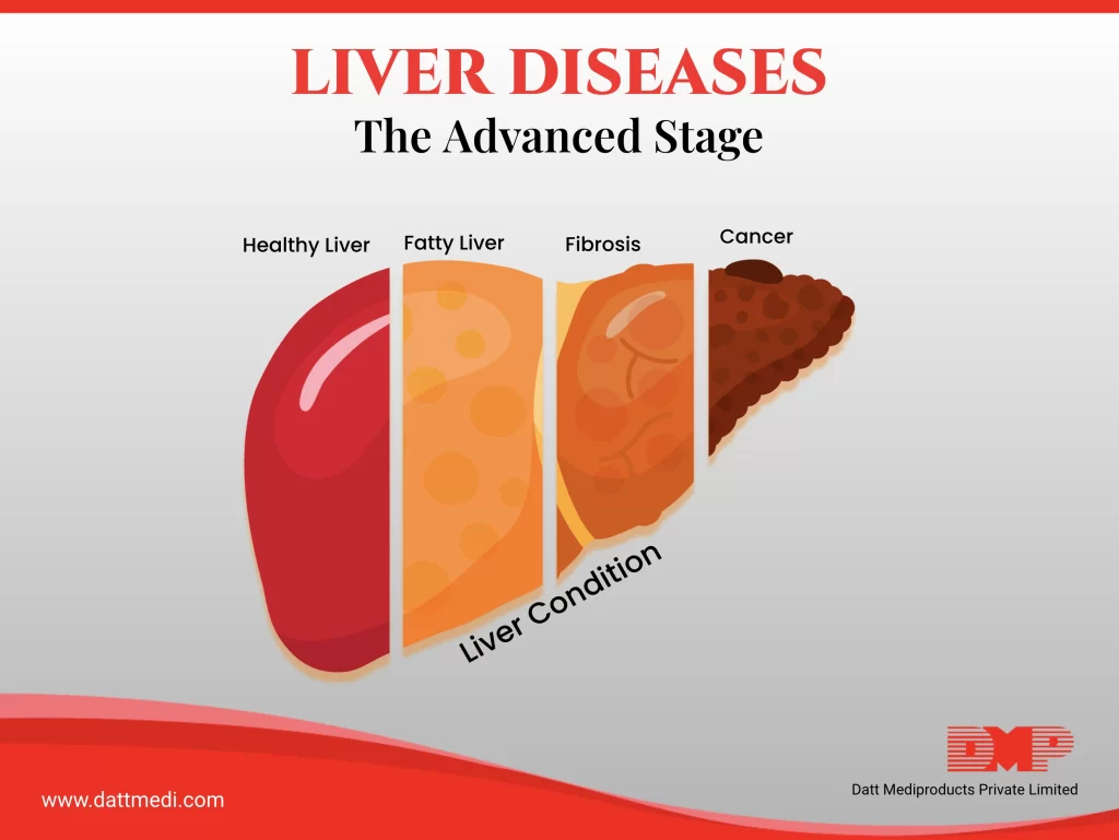 The Advanced Stages – Liver Diseases