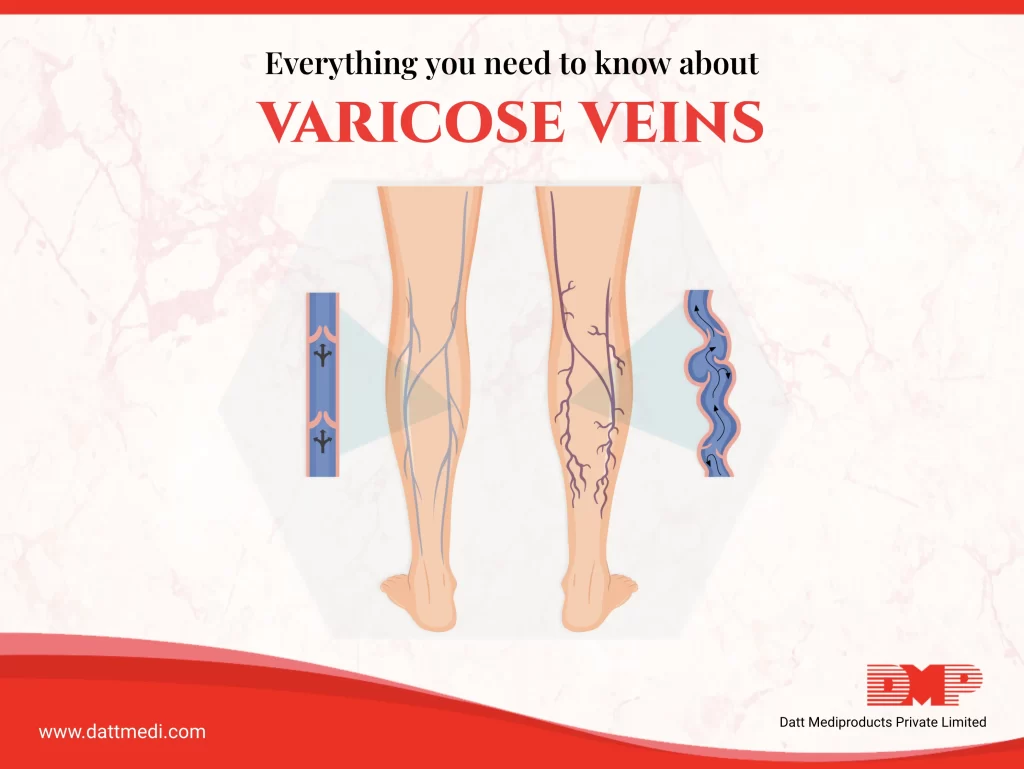 Varicose Veins