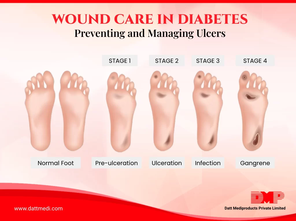 Wound Care in Diabetes