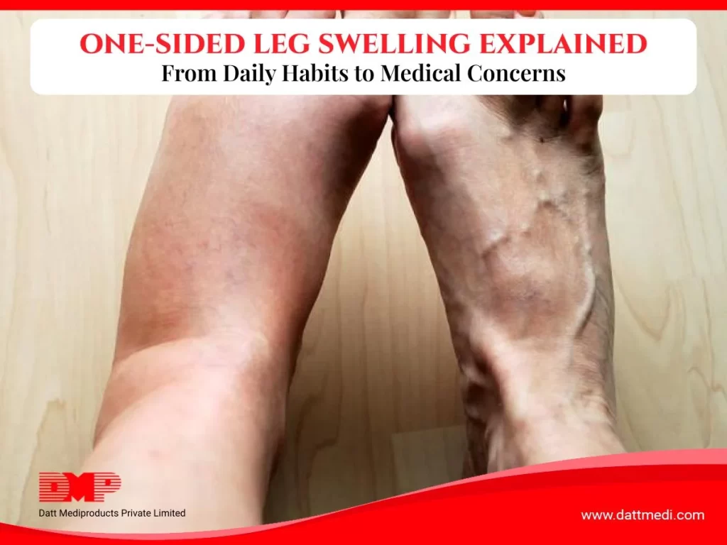 Unilateral leg swelling due to circulation issue